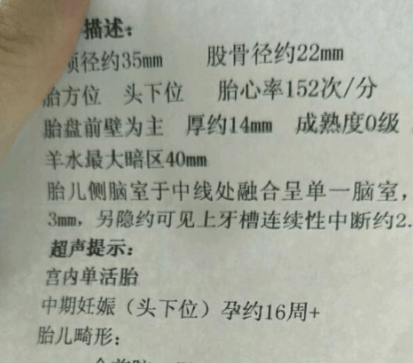 脑动静脉畸形治疗_全前脑畸形会误诊吗_脑动静脉畸形栓塞