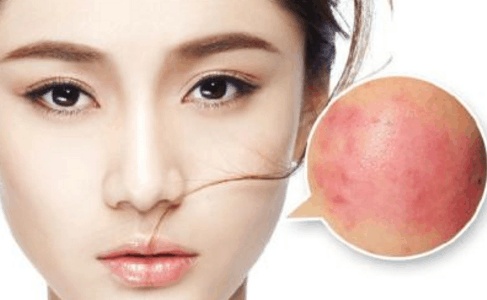 用了含激素的产品一定会得激素脸吗