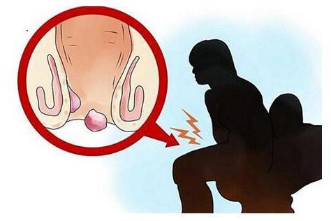 初期痔疮的症状图片