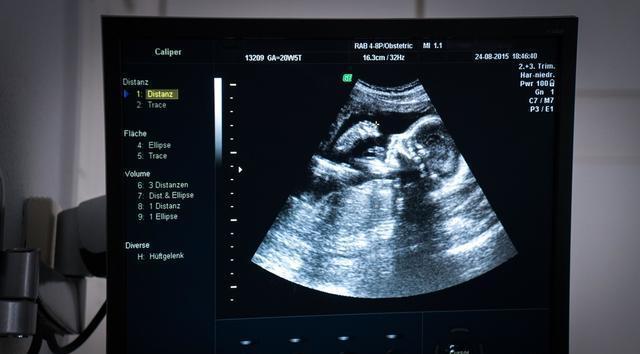 胎停一次, 终于知道有胎心后胎停的原因了