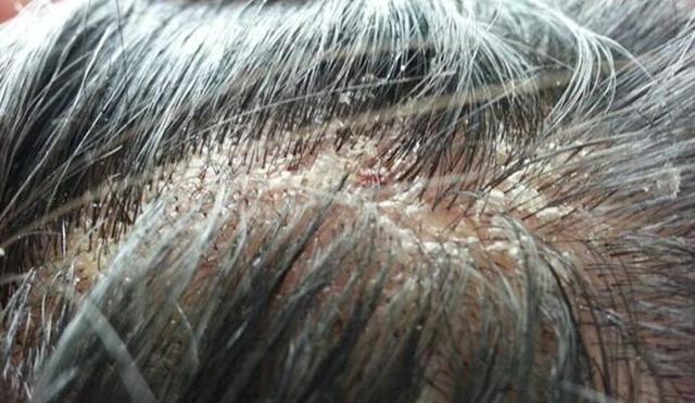 这3种洗发水等于在喂养头螨,医生给的3个简单