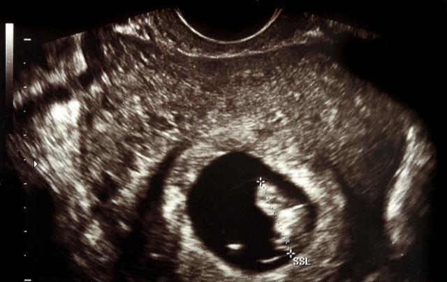 胎停一次, 终于知道有胎心后胎停的原因了