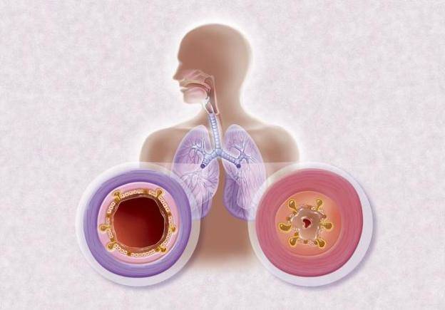 老年慢性支气管炎咳嗽有痰,咳不出?6种排痰方