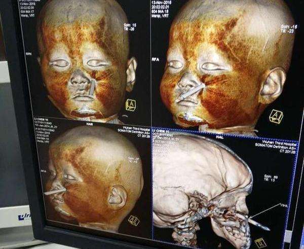 4岁男童不慎筷子插进脸颊,妈妈坚持不拔送医,大夫却称赞!