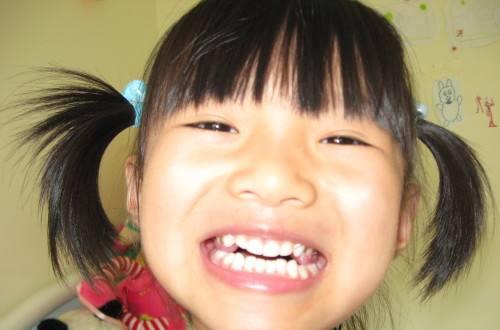 5岁女儿两颗门牙往外突,爸爸心急让孩子提早戴牙套,结果脸变形