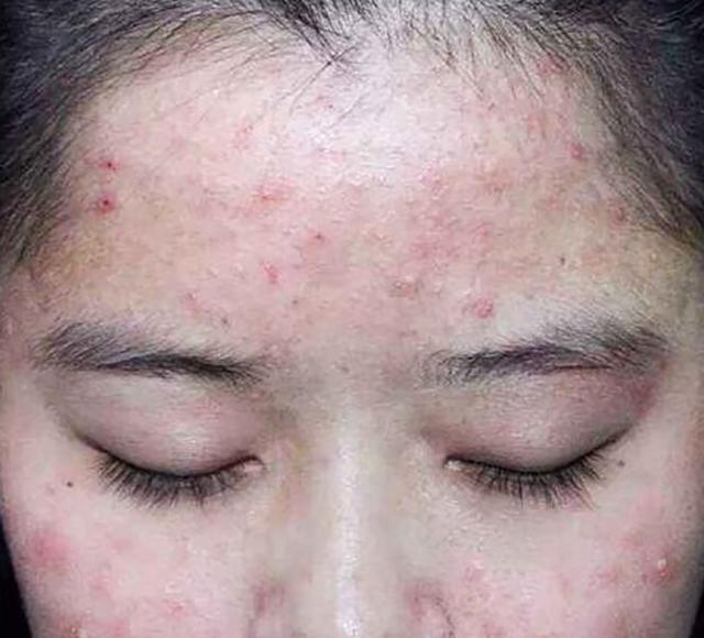 嘴巴周围反复长痘原因 痘痘反复发作怎么办