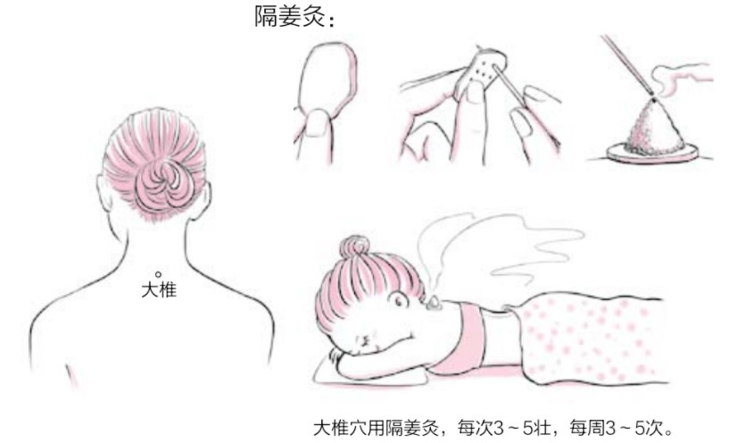 ?阳虚易得“空调病”,主灸四穴先扶阳