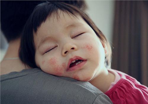 小宝宝过敏腹泻长湿疹,为什么妈妈要忌口?