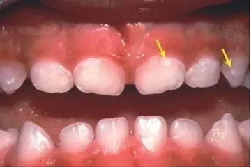 宝宝蛀牙了,医生也说不能弄,怎么办?