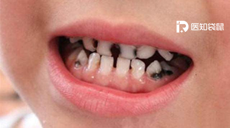 宝宝乳牙变黑龋坏，竟会引起这么多病!你却还在等换牙?