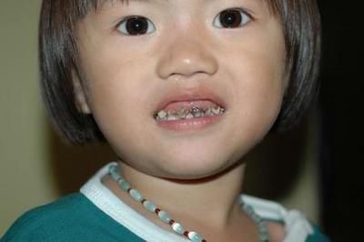 小小年纪,就一口黑牙,预防儿童蛀牙得从这些做