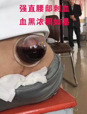 刺络放血疗法与强直性脊柱炎