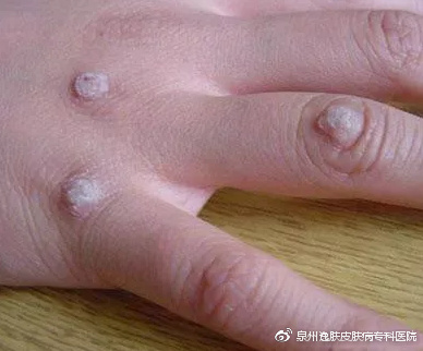 警惕,疣是一种传染病!不要把扁平疣再当作青春