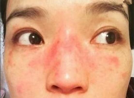 乱涂化妆品,得激素脸红肿痒干燥到底该怎么办