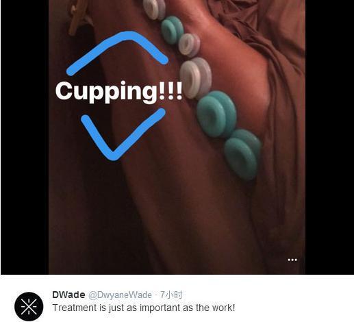 詹姆斯用拔火罐恢复身体 还有哪些NBA球员被
