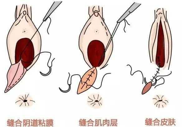 顺产侧切后, 缝合的时候为什么不打麻药, 会很疼