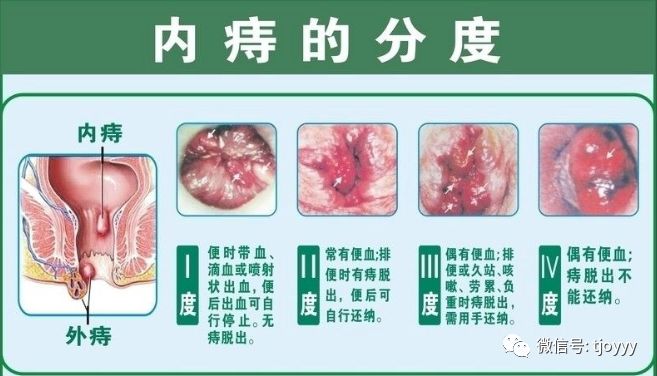 内痔脱出,无法缩回怎么办?这5招你肯定能用到