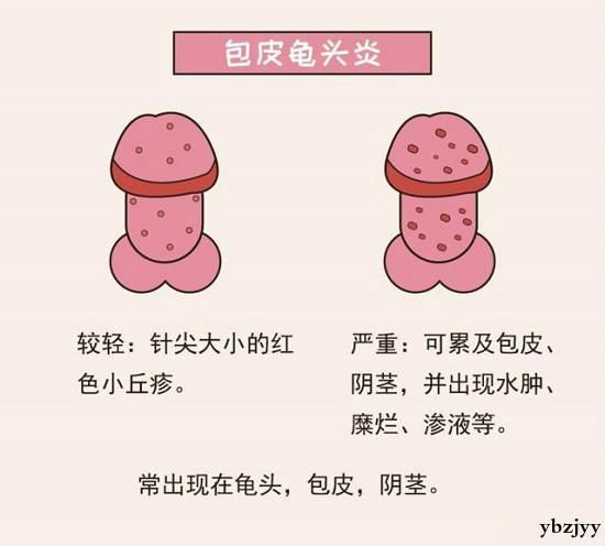 男人的冠状沟是哪里?长出的肉粒竟然是这些东