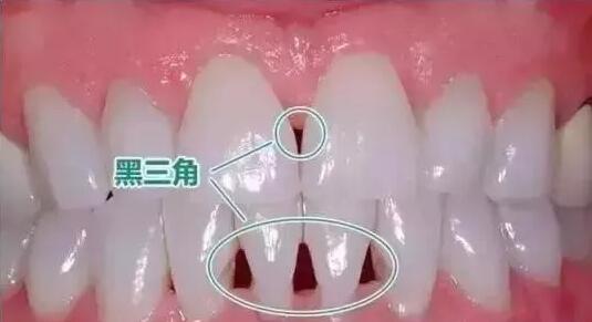 牙齿黑三角的恐怖 戴牙套的人需注意
