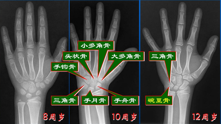 孩子长不高,为什么父母要给孩子骨龄检测
