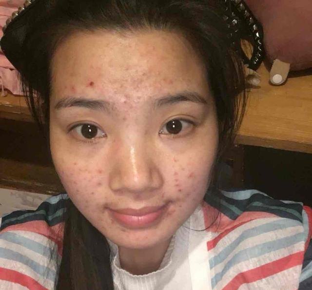 意外发现一个祛痘技巧竟然比药店的药膏还火