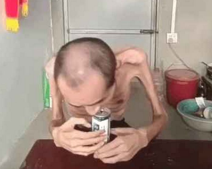 男子全身瘦骨嶙峋,只剩下一身骨架,原因却让人心酸不已