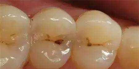 牙齿上面的小黑点是什么东西? 危害大吗?