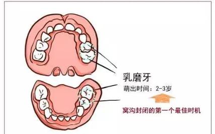 三是11-13岁时,第二恒磨牙萌出后,可以进行窝沟封闭.