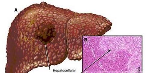 医生告诫:身上有这2种痣,要小心肝脏病变,最好