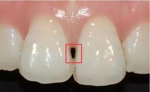 牙齿黑三角的恐怖 戴牙套的人需注意