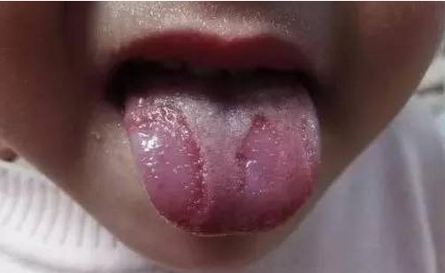 宝宝地图舌危害多大?医生专业深度分析,妈妈