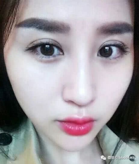 次双眼皮修复成功的真实案例,效果前后对比图