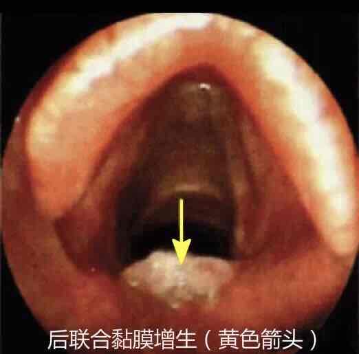咽喉反流性疾病的一些知识