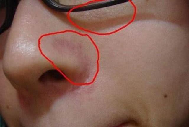 鼻子上长黑点点,一挤就出来白白的一条,到底怎