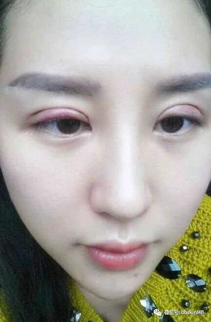 次双眼皮修复成功的真实案例,效果前后对比图