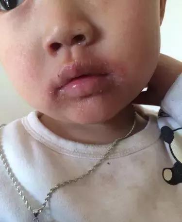 宝宝嘴唇干不一定是缺水, 可能是病!