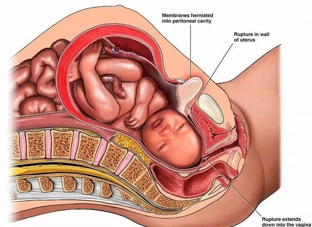 一胎剖腹产,疤痕子宫再孕,二胎还可以顺产吗?