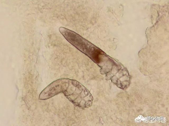 鼻子两侧挤出白色长条分泌物是什么?