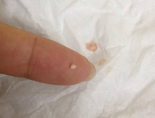 鼻子上长黑点点,一挤就出来白白的一条,到底怎