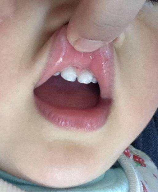 宝宝乳牙上出现\