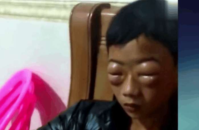 小伙被蜜蜂蛰后眼睛肿成了这样,网友:难道奥特