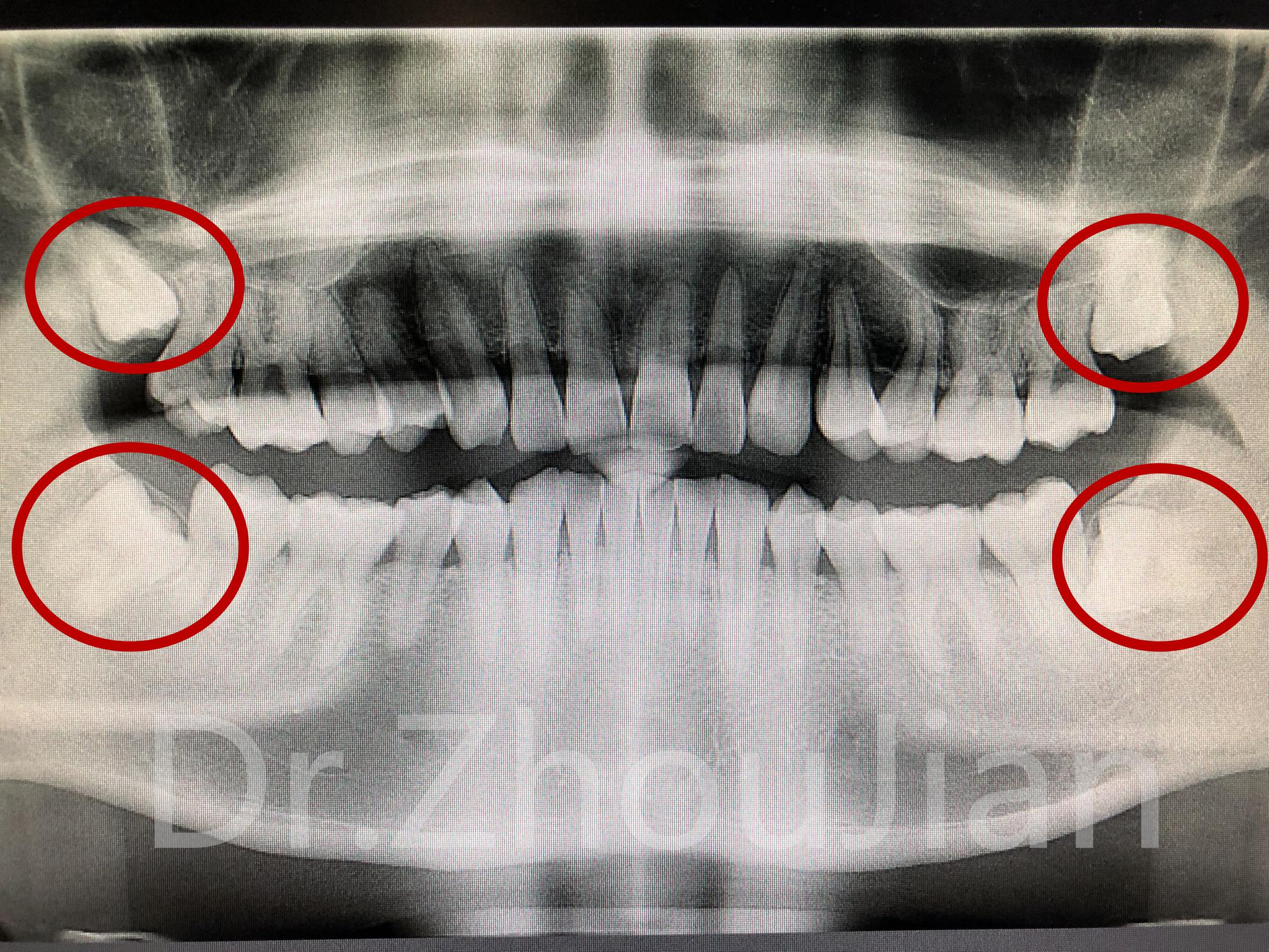 矫正前为何要拍牙片呢?会不会辐射很大呢?