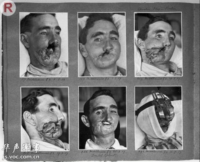 第一次世界大战中的战场救护和伤员图片等