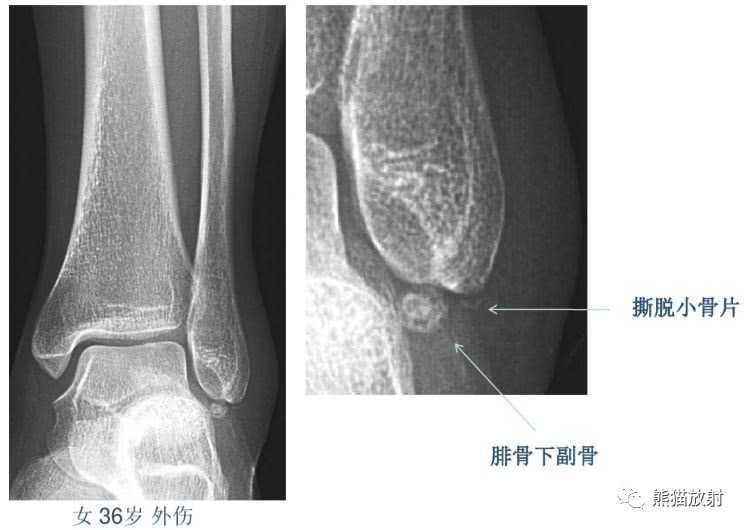 籽骨、副骨、永存骨骺、撕脱骨折?读完此文,你