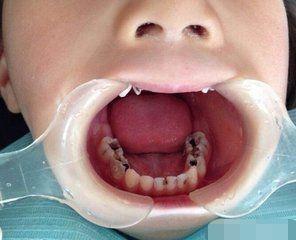 三岁孩子从不吃糖却满嘴烂牙,父母到诊所补牙