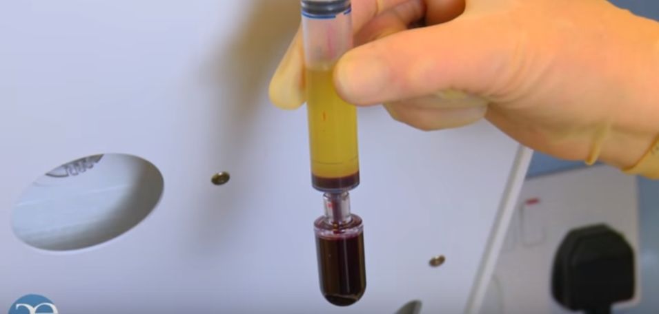 这就是最近几年炒得火热的prp(platelet-rich plasma,富血小板血浆)