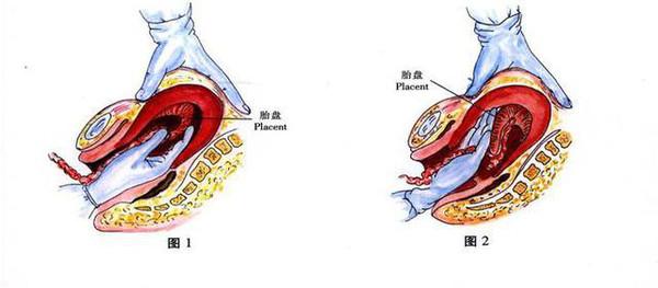 听说手剥胎盘比生孩子疼100倍,你对手剥胎盘了解多少?