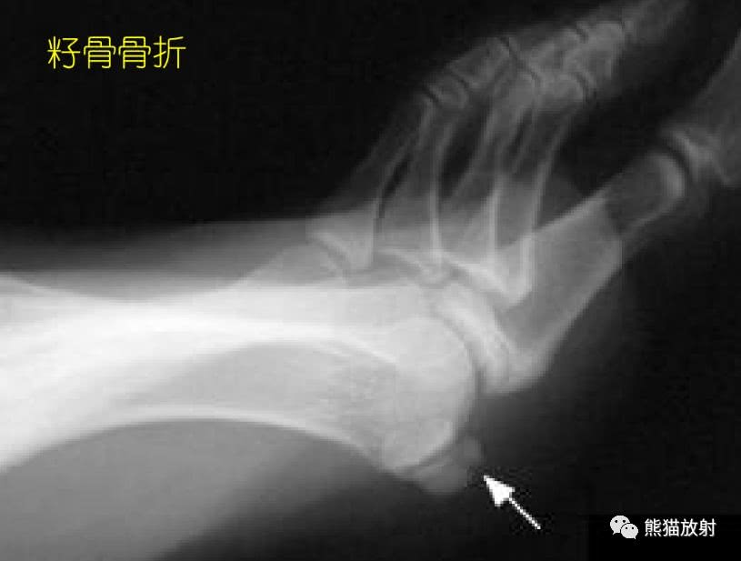 籽骨、副骨、永存骨骺、撕脱骨折?读完此文,你