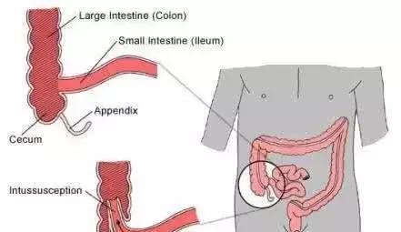 正确认识肠套叠! 宝妈们不要再误以为是肠绞痛了!