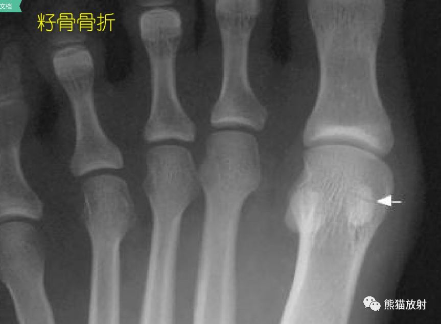 籽骨、副骨、永存骨骺、撕脱骨折?读完此文,你